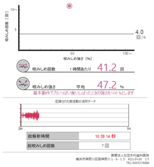 画像B(咀嚼時の例:比較的負担が少ないケース)